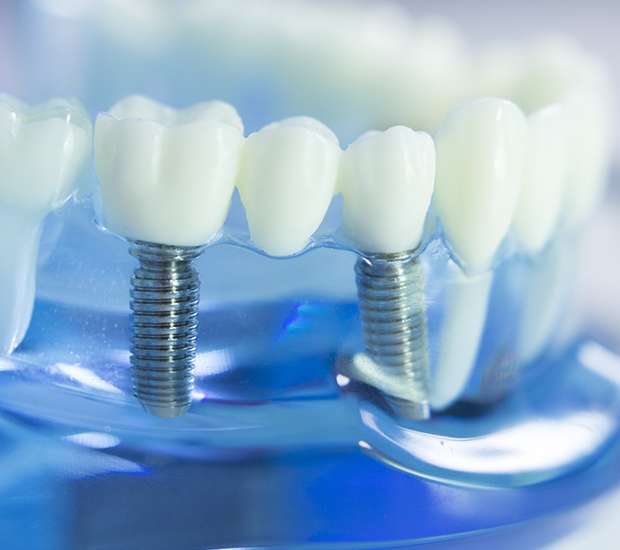 Morrisville Dental Implants