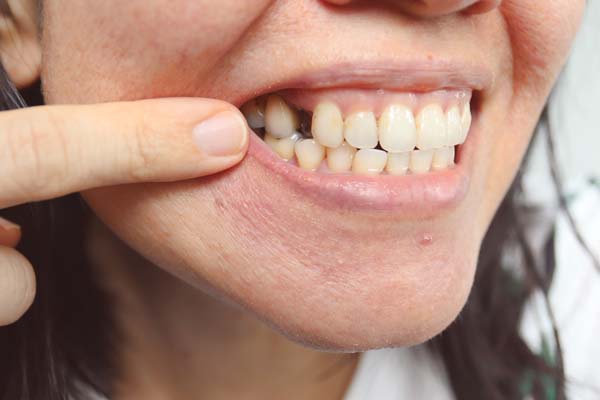 Long Term Problems Caused By A Missing Tooth